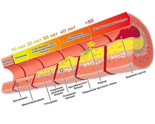 Атеросклероз сосуда