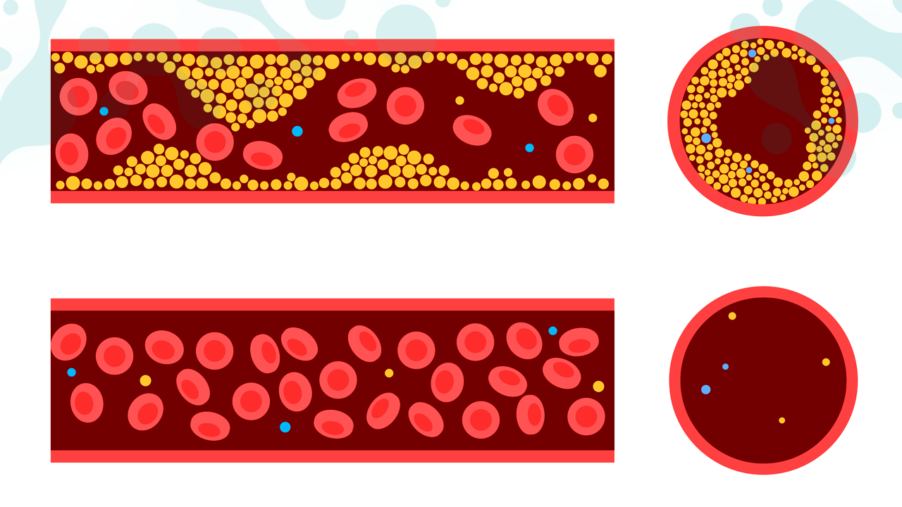 Атеросклероз сосудов
